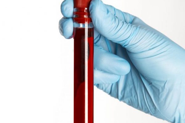 bilirubin-direkt-testi