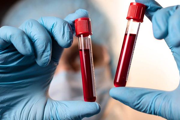 bilirubin-total-testi