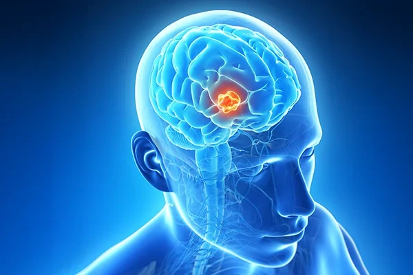 Beyin Tümörleri