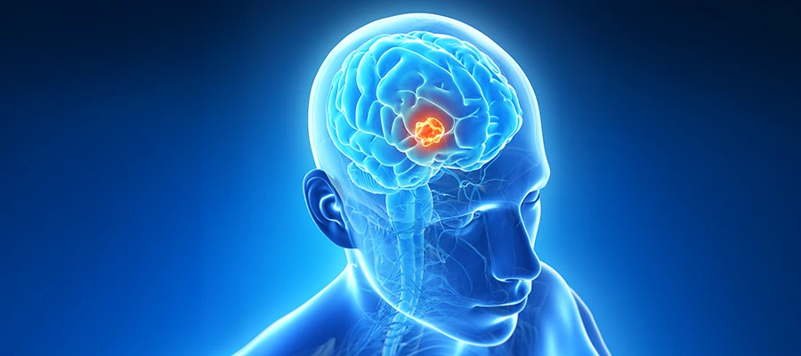 Beyin Tümörleri